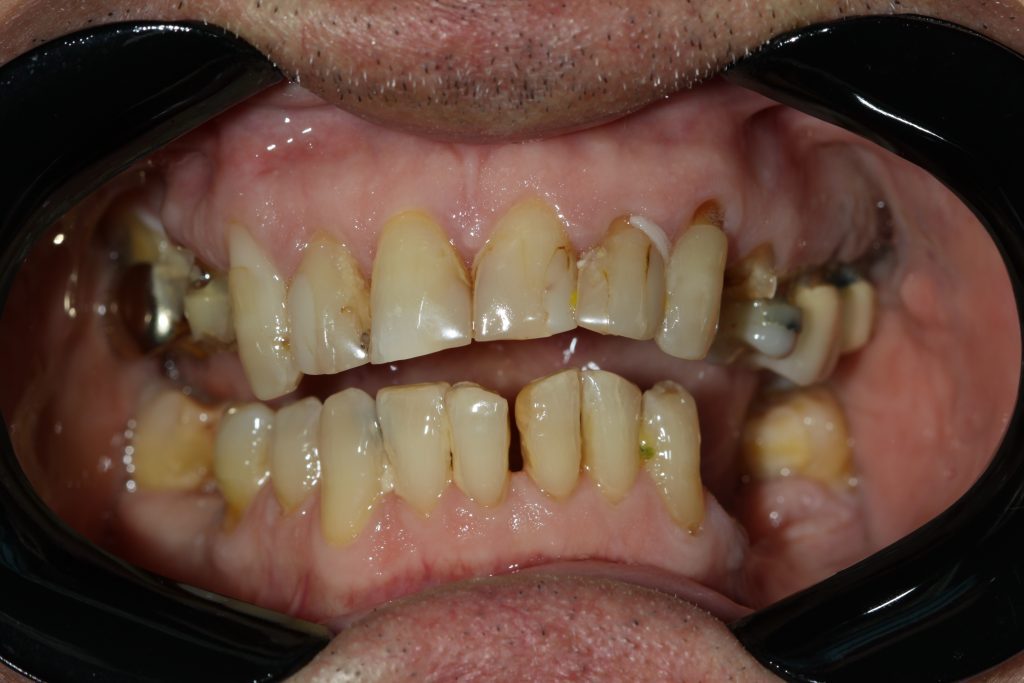 Custom dental trays made at The Smile Spot