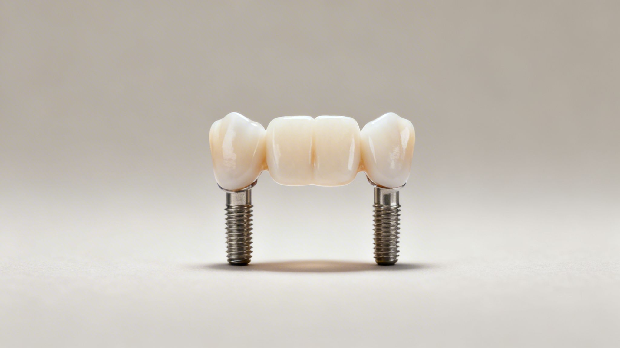 A close-up of a three-unit ceramic dental bridge supported by two metal implants on a light background.