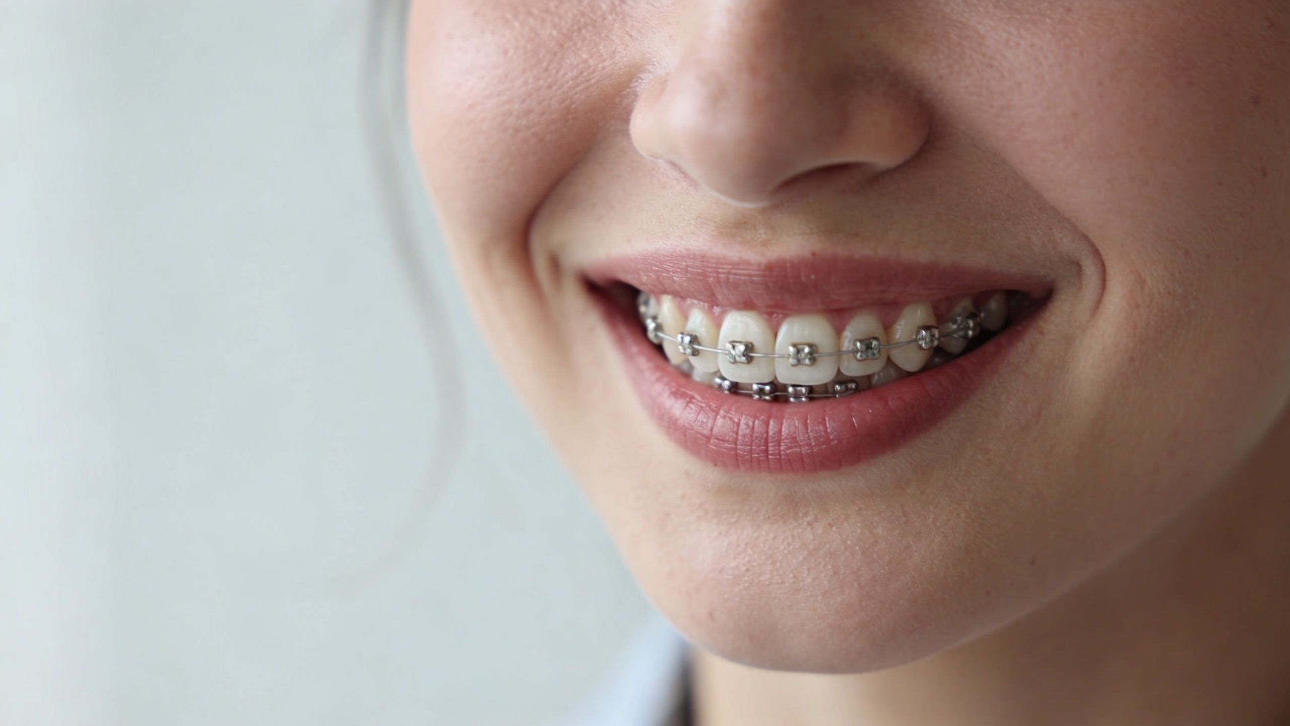 A close up view of a smiling woman showing her teeth with silver metal orthodontic braces applied.