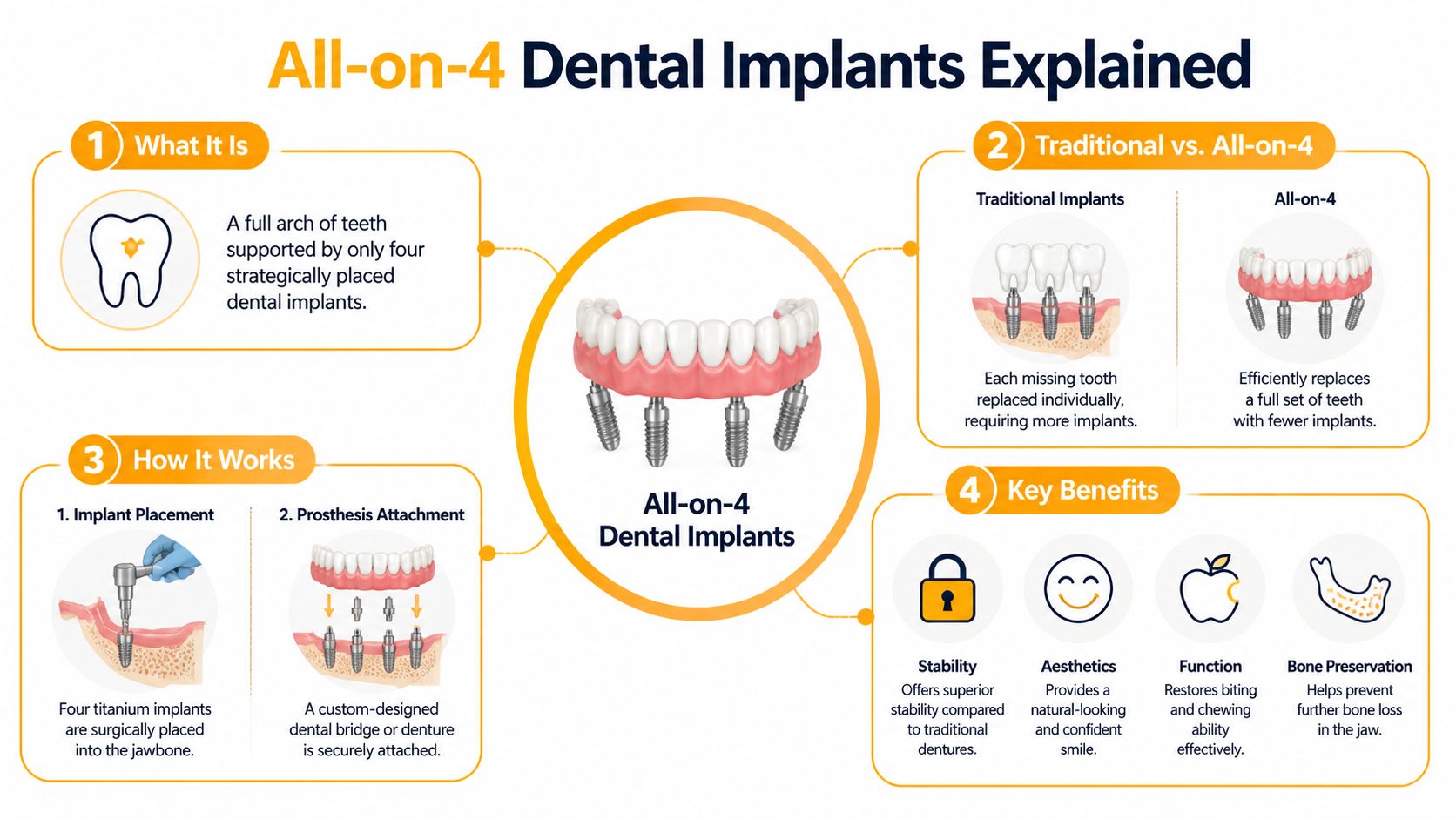 An infographic explaining how All-on-4 dental implants use four strategically placed implants to support a full bridge.