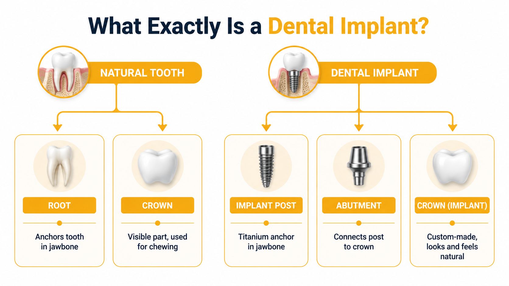 A diagram comparing the anatomy of a natural human tooth with a dental implant replacement system.