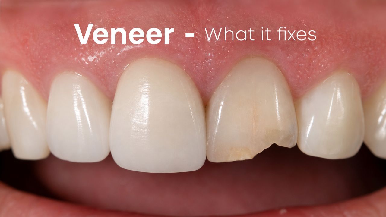 Close-up of a person's upper front teeth, showing one tooth with a chip that dental veneers fix.