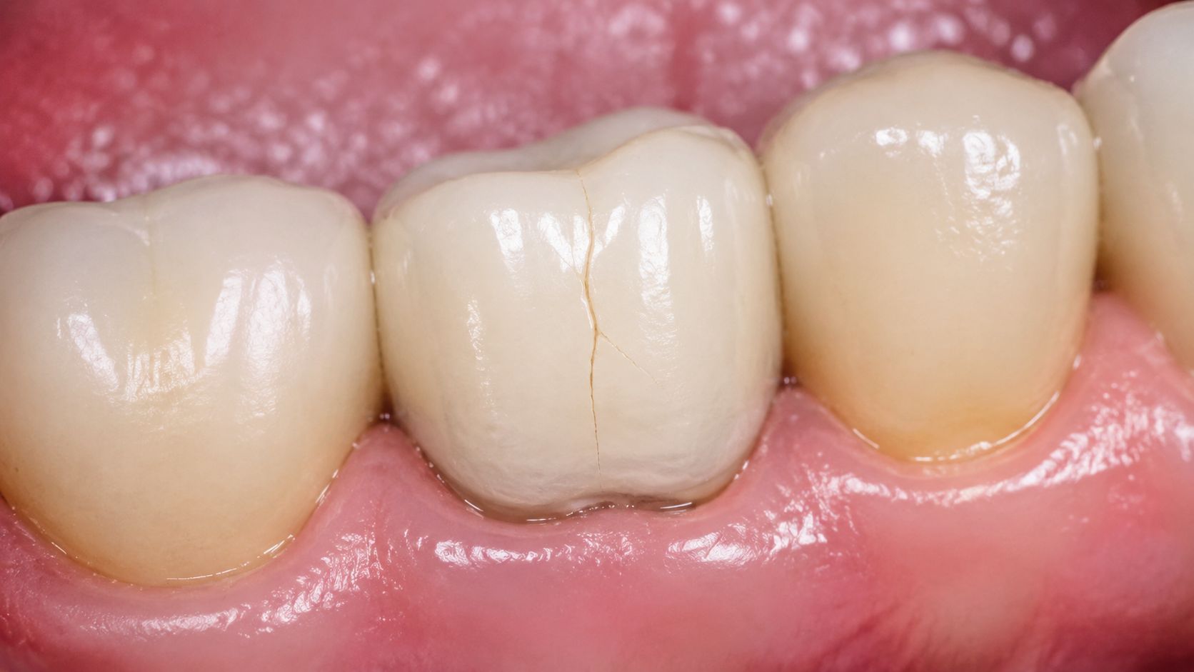 A close-up view of human teeth showing a visible vertical crack on a porcelain dental crown restoration.