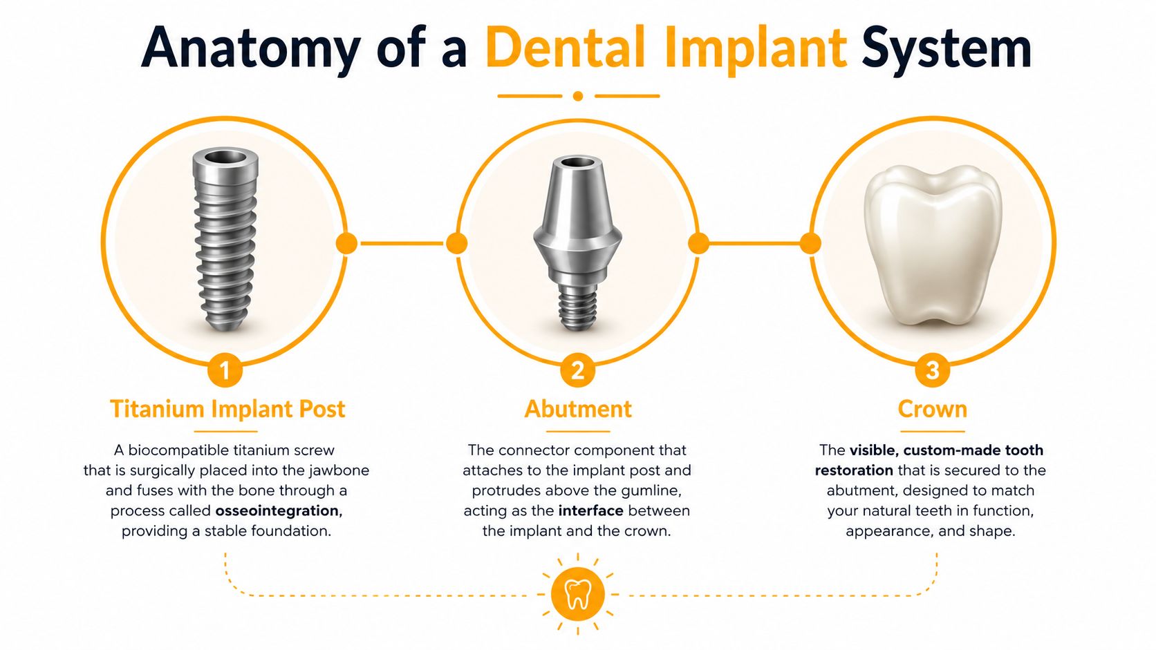 A diagram illustrating the three main components of a dental implant system: post, abutment, and crown.