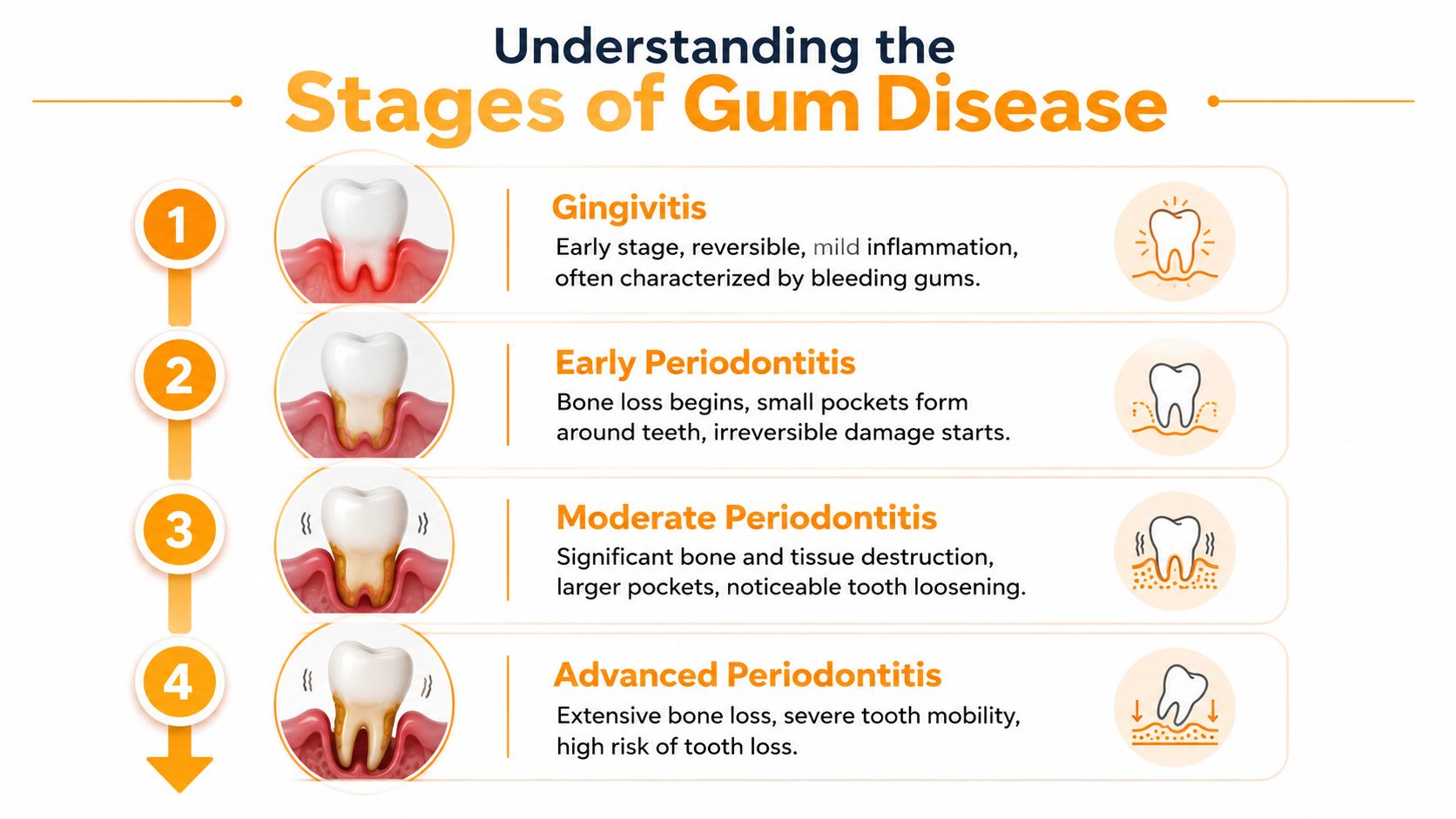 An infographic showing four progressive stages of gum disease from gingivitis to advanced periodontitis and tooth loss.